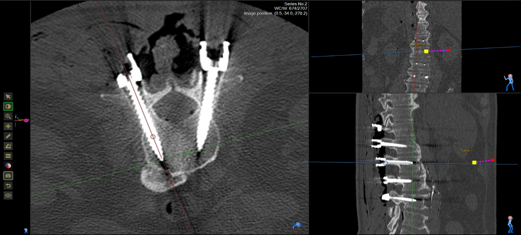 Full CT verification screenshot with axial and dual sagittal views