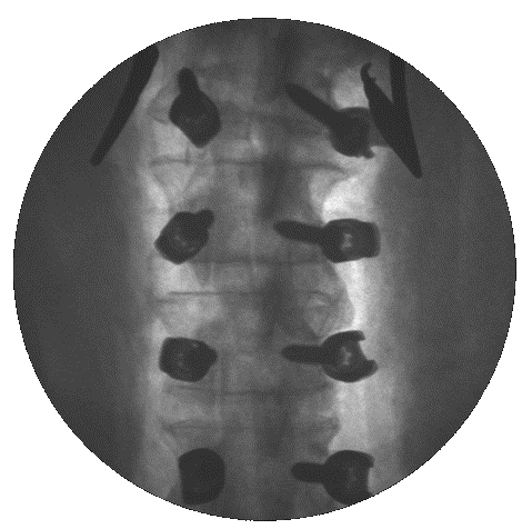 Intraoperative AP fluoroscopic view