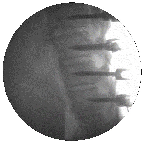 Intraoperative lateral fluoroscopic view