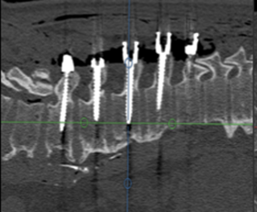 CT verification of pedicle screw placement