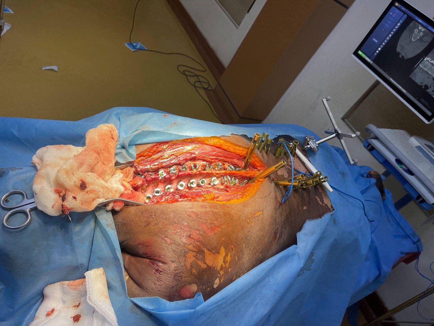 Completed surgical site following MIS insertion