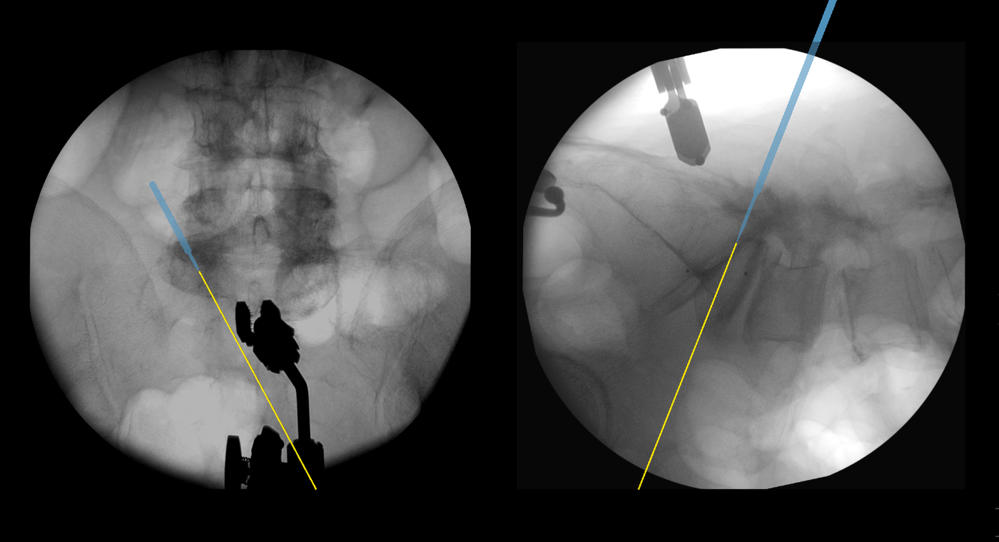 Real-time tool tracking interface, AP and lateral fluoroscopic overlay
